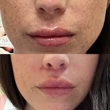 Day 9 post lip lift, sutures removed day 8. Still very happy! :  r/PlasticSurgery