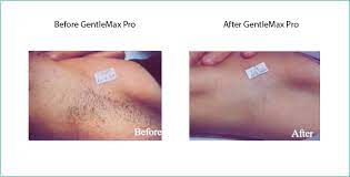 Explore a wide range of the. Laser Hair Removal Eagan Mn Renew Medspa