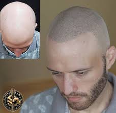 The Non-Invasive and Cost-Effective Hair Loss Solution