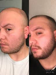 You can click the photo to see high resolution images. 4 Month Update 30yrs Old Finasteride 1mg Day And Minoxidil 5 Liquid 2x Daily On Face And Head Never Missed A Day Minoxbeards