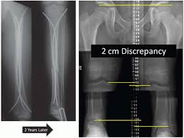 Image result for Functional Leg Length Discrepancy