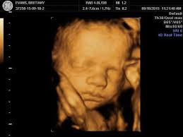 Alibaba.com offers 433 baby heart ultrasound products. Hair On 3d Ultrasounds Glow Community