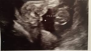Gender Wrong At 12 Weeks Was Told Boy Now 18w Girl The Bump