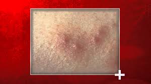 Image result for bedbug bites look like