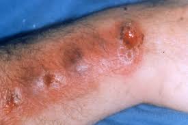 This fungal disease usually affects the skin, although other rare forms can affect the lungs, joints, bones, and even the brain. Sporothrix Schenckii Infectious Disease Advisor