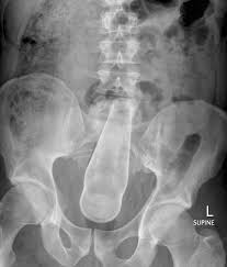 Bottom Bottle Lol Is This The Bottle Professor Fanger Was Talking About Emergency Medicine Radiology Imaging X Ray