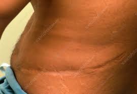 Scar Caused By Kidney Surgery Stock Image M575 0015 Science Photo Library