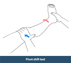 Image result for Pivot Shift Test