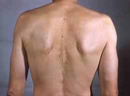 Although we all have fungus living on our skin, the out of control growth of such fungus. Tinea Versicolor Knowledge Amboss