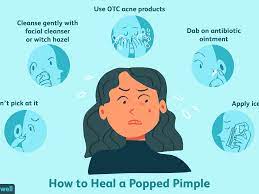 How To Heal A Popped Pimple Scab