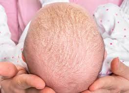 Image result for white scabs on the head in children
