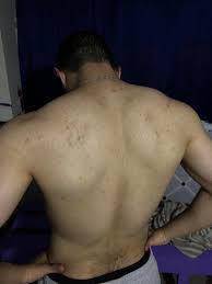 100% money back guarantee · read our reviews now · featured in webmd 25m Any Advice On How To Get Rid Of Bacne Scars I Had Bad Back Acne Few Years Ago That I Didn T Treat And Now This Is What S Left Skincareaddicts