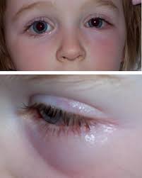 Image result for Allergic Conjunctivitis