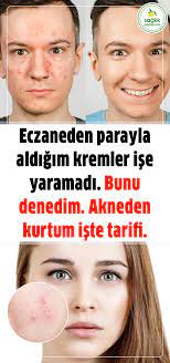Aknenin Dogal Ilaci Mutfaginizdan Natural Treatments Health Fitness Skin Care