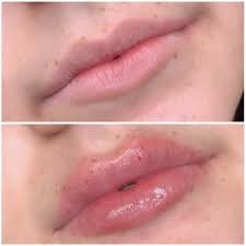 Vous serez tout d'abord séduit par le design beau, élégant et moderne de cet appareil qui renferme un revêtement solide et robuste. Hyaluron Pen Pour Repulper Ses Levres A La Maison Mode D Emploi