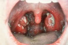 Why does tonsil get swollen? Tonsillectomy Adenotonsillectomy Kidshealth Nz
