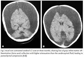 Menkes Disease As A Differential Diagnosis Of Child Abuse