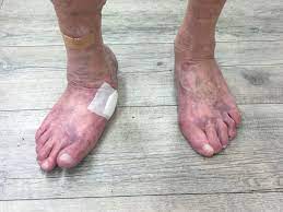 Aufgrund einer erheblichen schwäche brechen. Charcot Fuss Diabetischer Fuss Mit Spontanbruchen Bei Polyneuropathie