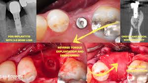 Although surgery is often necessary to reverse significant bone loss, you can prevent bone loss by maintaining a good dental care. Removal Of A Dental Implant With Advanced Bone Loss Followed By Bone Grafting For Replacement With A New Dental Implant Removal Of A Dental Implant With Advanced Bone Loss Followed By