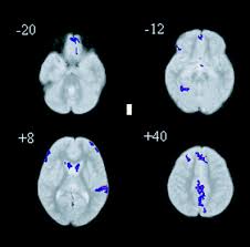 Asperger syndrome and other terms // the national autistic society. Neuroimaging Of Autism Springerlink