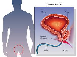 Prostate cancer usually grows very slowly, and finding and treating it before symptoms occur may not improve men's health. Prostate Cancer Treatment Is Often Inadequate