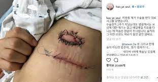 의료사고 양쪽 무릎에 퇴행성 관절염으로 고생하던 50대 a씨는 정형외과에 내원해서 진료를 받고 담당의사는 무릎 관절강내에 주사를 맞으면 증상이 호전될. í•œì˜ˆìŠ¬ ì§€ë°©ì¢… ìˆ˜ìˆ ë°›ë‹¤ ì˜ë£Œì‚¬ê³  ì˜¬ë¦° ì‚¬ì§„ ë³´ë‹ˆ ì¤'ì•™ì¼ë³´
