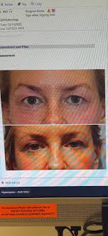 EYES: I've had a condition called nocturnal lagophthalmos since I was a kid  which means that when I sleep, my eyes remain slightly open and the lids do  not fully close. (Kinda