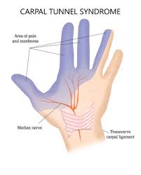Pursuing Workers Compensation For Carpal Tunnel Injuries