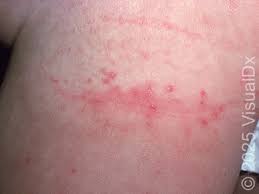 Image result for diaper dermatitis