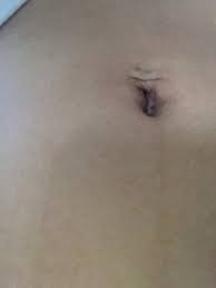 My Naval Piercing Is Saggy After Pregnancy How Could I Fix This Photo