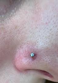 Nose Piercing Bump What Do I Do Details In Comments Piercing