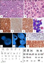 I was recently diagnosed with gray zone lymphoma. Gray Zones Around Diffuse Large B Cell Lymphoma Conclusions Based On The Workshop Of The Xiv Meeting Of The European Association For Hematopathology And The Society Of Hematopathology In Bordeaux France