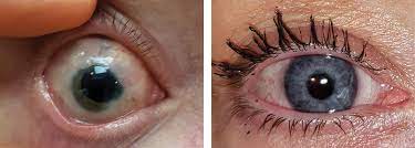 Maybe you would like to learn more about one of these? Colored Contacts More Than A Pretty Eye