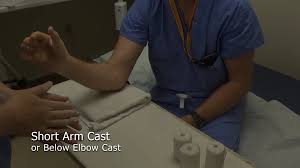 Image result for Short Arm Cast