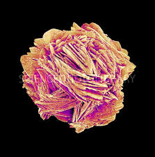 Kidney Stone Coloured Scanning Electron Micrograph Sem Kidney Stones Are Usually Fo Scanning Electron Micrograph Scanning Electron Microscope Kidney Stones