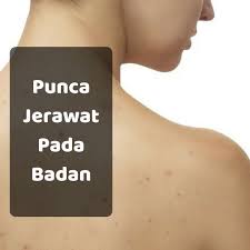 Jerawat adalah salah satu masalah kulit yang menyebalkan. Punca Jerawat Belakang Badan Mbh Beauty Academy