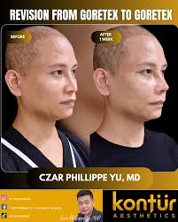 PAHELP PLS ANO PO MAS BETTER SILICON,GOROTEX OR CARTILAGE GOROTEX??