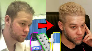 Should i use minoxidil empty stomach, before food or after food? Finasteride Ru58841 And Minoxidil 10 Years Later Before After Results Anabolic Tv