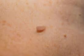 Thrombosed external hemorrhoids develop a deep red, deep purple, blue or black tint, often appearing just underneath the skin. Skin Tag Removal Why You Shouldn T Diy Health Essentials From Cleveland Clinic