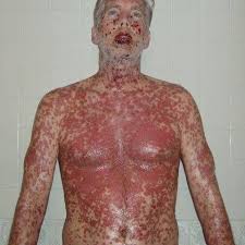 Steven johnson syndrome and motrin. Stevens Johnson Syndrome Sjs Tens Home Facebook