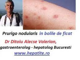 In general, dispare de la sine. Pete De La Ficat 0758751841 Cabinet De Gastroenterologie Si Hepatologie Bucuresti