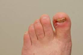 When You Lose Weight Do Your Feet Get Smaller