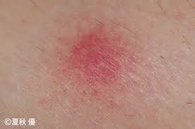 Jul 23, 2016 · 蚊に刺された後、赤みやかゆみだけでなく、高熱が出たり、なかなか治らない深い傷ができたときは、蚊アレルギーとも呼ばれている「蚊刺（ぶんし）過敏症」の可能性があります。 è™«ã•ã•ã‚Œãƒã‚§ãƒƒã‚¯ æ±äº¬2020 ã‚¢ãƒ¼ã‚¹è£½è–¬