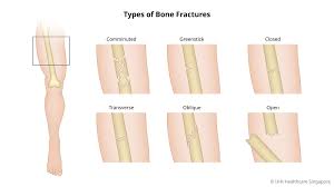 Image result for Fracture Types