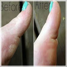 Listerine foot soak is one of the best ways to pamper your feet which is the most neglected part of your body. Vinager And Listerine Foot Soak Apple Cider Vinegar Listerine Foot Soak Listerine Foot Soak Fail Diy Foot Soak Dry Skin On Feet Listerine Foot Soak