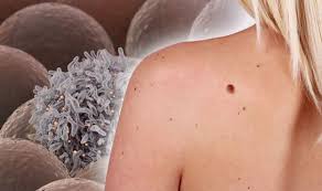 If you have skin cancer, it is important to know which type you have because it affects your treatment options and your outlook (prognosis). Skin Cancer Symptoms Warning Signs Your Mole Is Melanoma How To Prevent It Express Co Uk