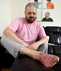 Apply a cool compress or ice pack over the. Ex Emmerdale Actor Could Lose His Foot After Spider Bite On Las Vegas Boys Trip Leaves Him With Gaping Hole