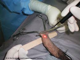 Laser Surgery In Urology Circumcision Prostate Stone