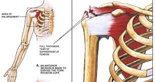 Image result for Rotator Cuff Rupture
