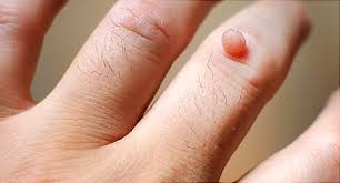 Foot warts are usually on the soles (plantar area) of the feet and are called plantar warts. Warts Pictures Causes Types Removal And Treatment